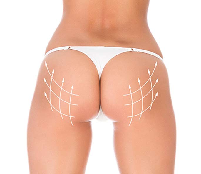 gluteoplastia